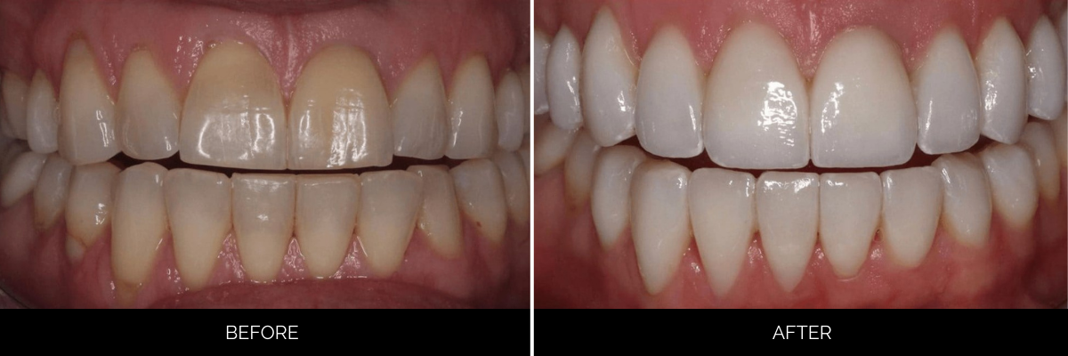 Before and after full mouth restoration showing stained, worn upper and lower teeth whitened and reshaped