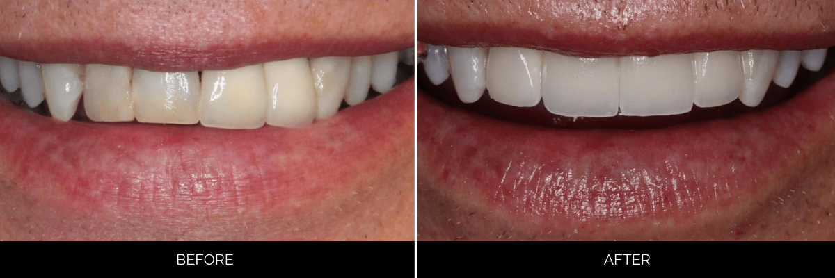 Before and after cosmetic dentistry showing slightly misaligned teeth brightened to a uniform, radiant smile