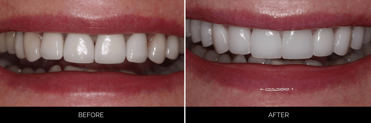 Before and after smile transformation showing dull, irregular teeth enhanced to bright, symmetrical teeth