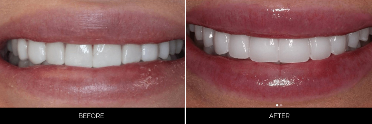 Before and after smile showing whitened and reshaped teeth with improved alignment