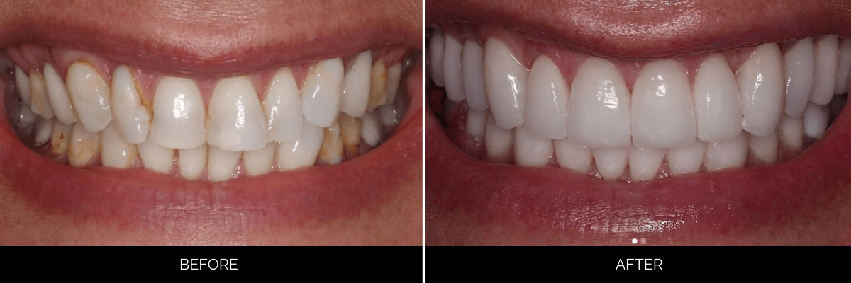Before and after smile showing teeth whitening and cosmetic bonding for brighter, uniform appearance