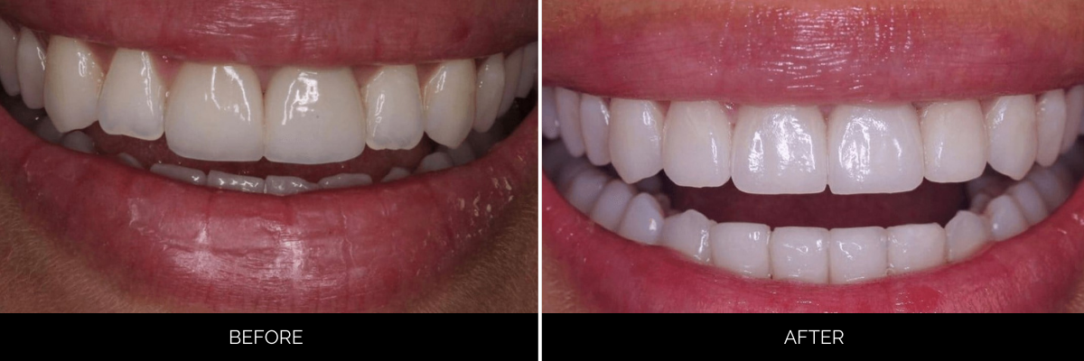 Before and after smile showing veneers improving tooth shape, color, and overall smile aesthetics