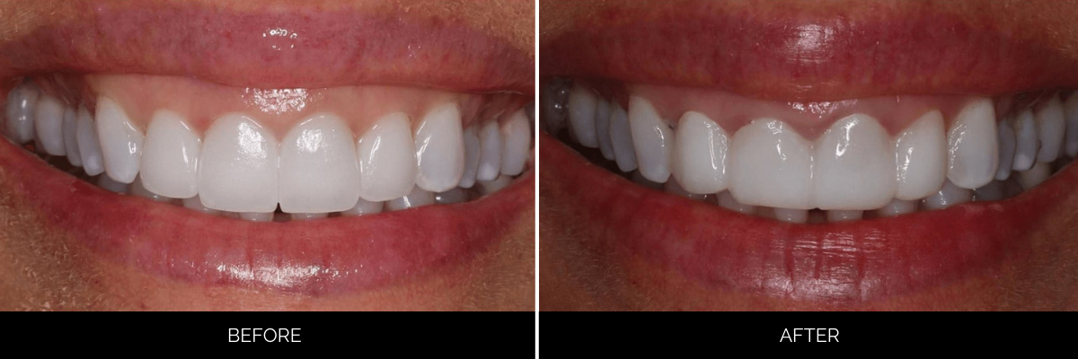Before and after smile displaying full-mouth veneers with improved tooth whiteness and symmetry