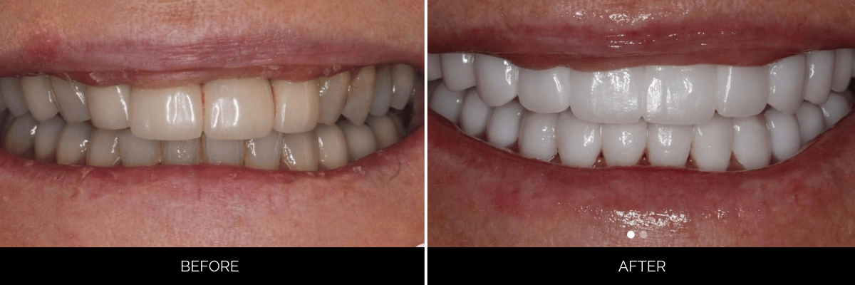 Before and after smile demonstrating veneers enhancing tooth color and straightness