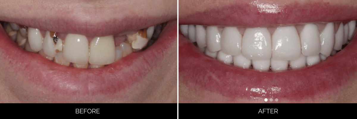 Before and after smile showing veneers restoring tooth structure and creating brighter smile