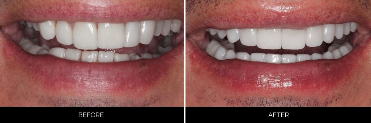 Before and after smile revealing veneers correcting tooth discoloration and spacing
