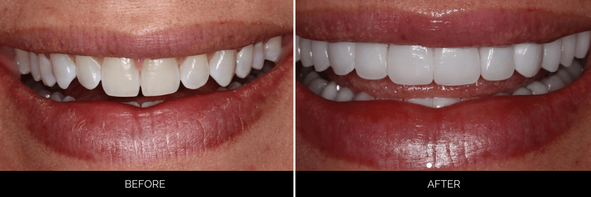 Before and after smile displaying veneers with enhanced tooth color and uniform appearance