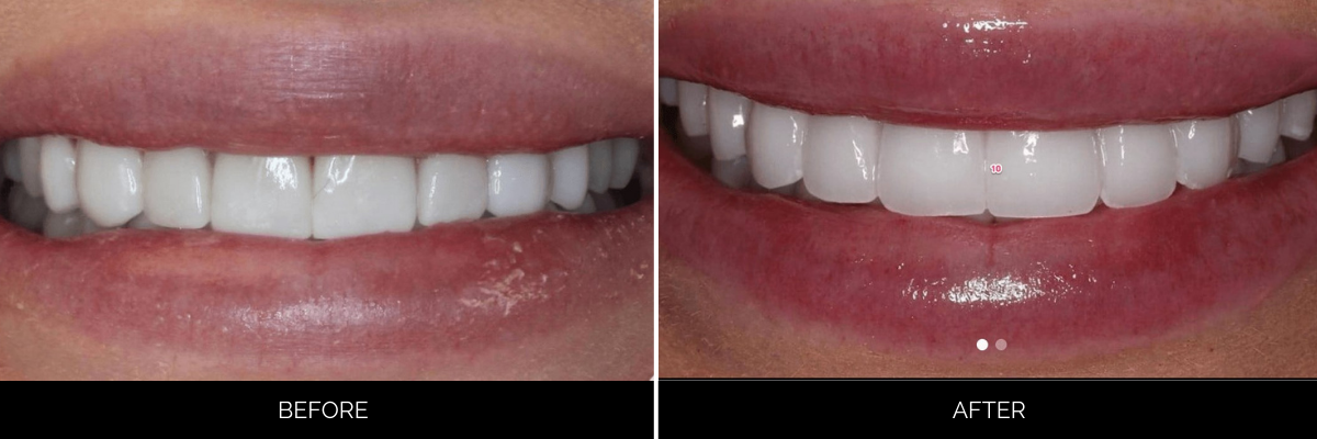Before and after smile showing cosmetic dental veneers transformation with improved tooth shape and alignment