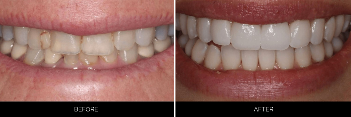 Before and after smile showing crowded lower teeth corrected and whitened with cosmetic dentistry