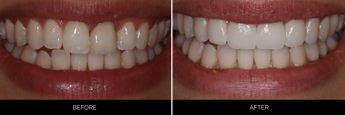 Before and after smile showing gapped and discolored teeth restored with cosmetic veneers