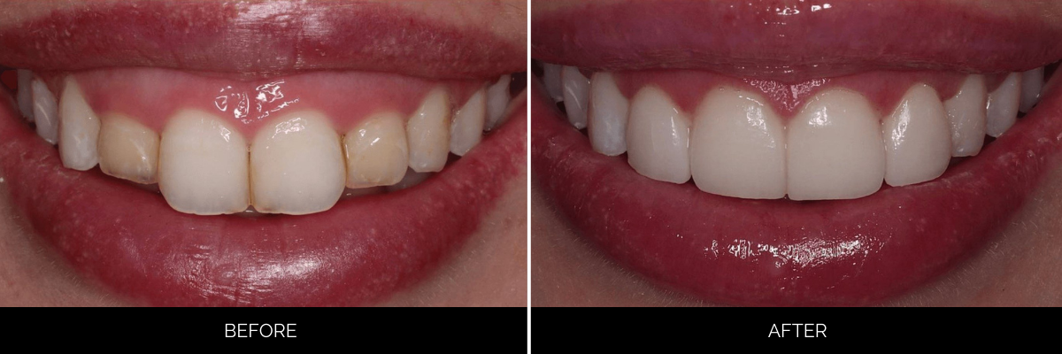 Before and after close-up smile showing yellowed front teeth brightened with professional whitening
