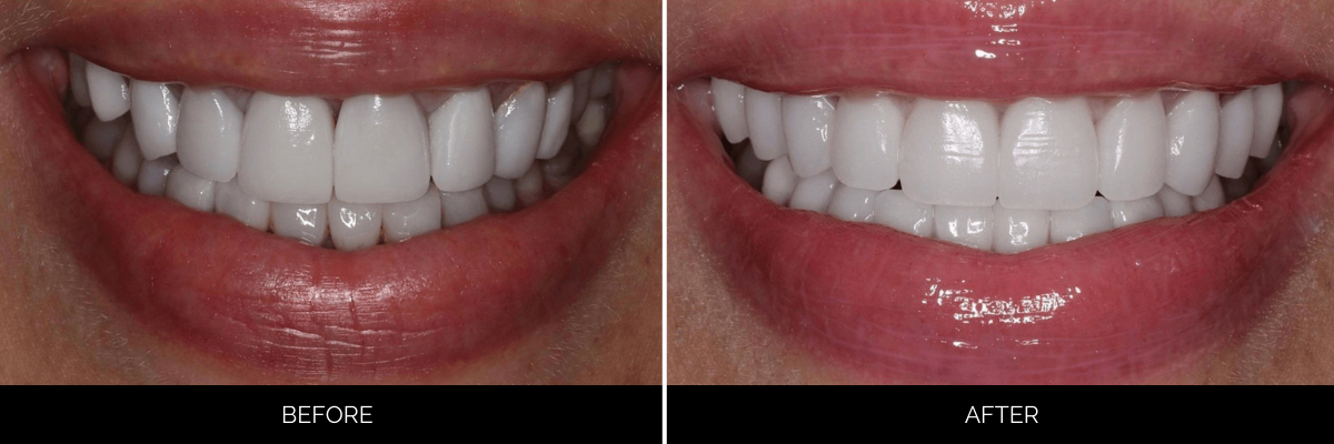 Before and after full smile showing uneven teeth whitened and aligned with cosmetic dental work