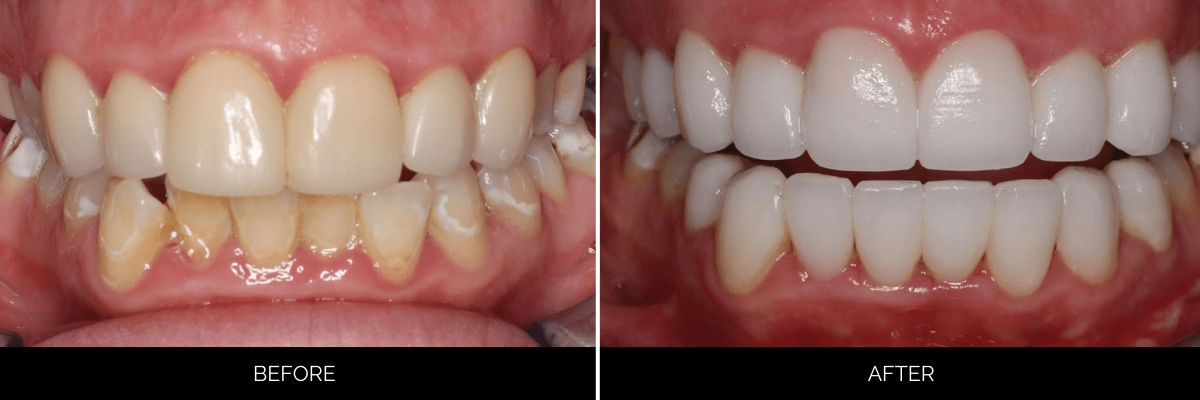 Before and after smile showing severe discoloration and misalignment corrected with cosmetic veneers