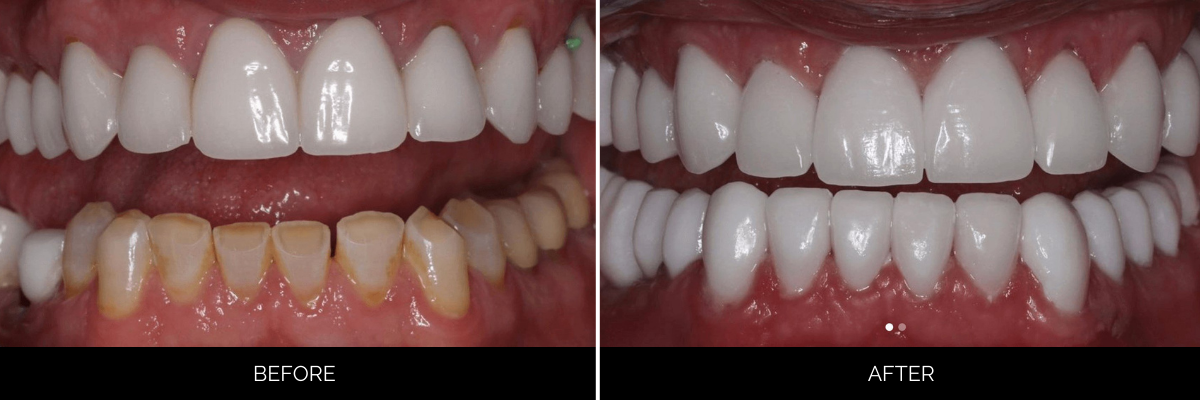 Before and after smile showing upper teeth whitening and lower teeth restoration with veneers