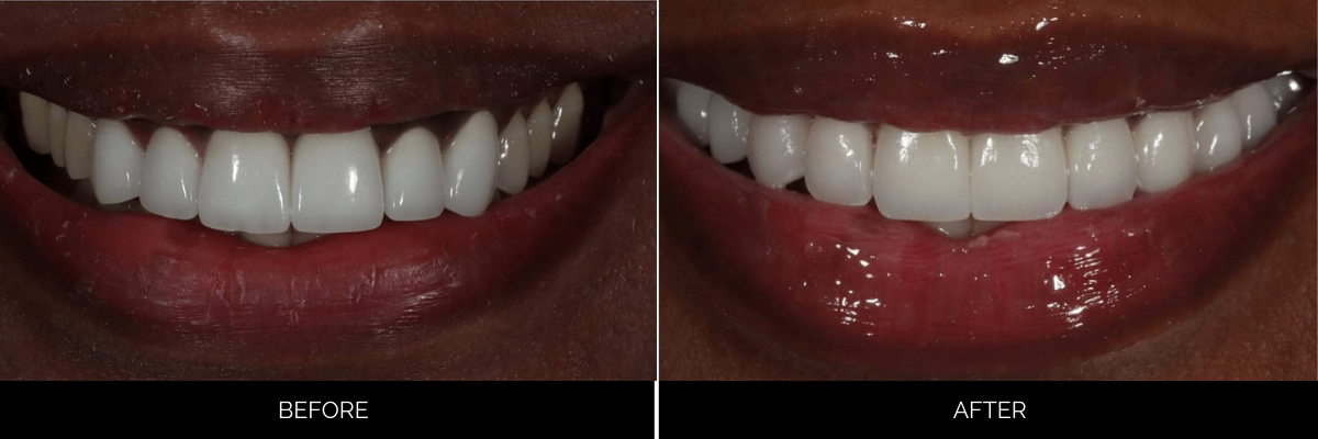 Before and after upper veneers: uneven, yellowed teeth restored to bright, symmetrical smile