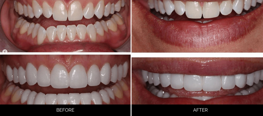 Before and after full-mouth veneers showing four views: crooked, discolored teeth transformed to bright, aligned smile