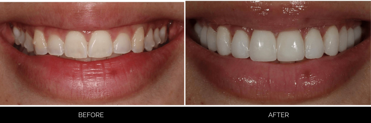 Before and after cosmetic veneers: stained, misaligned upper teeth corrected to bright, aligned smile