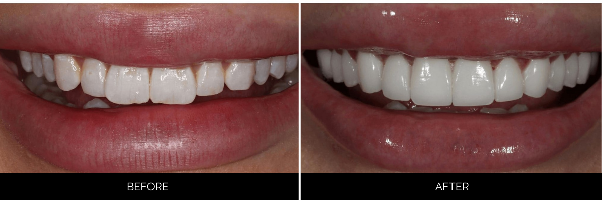 Before and after upper teeth veneers: yellowed, worn teeth restored to white, even smile