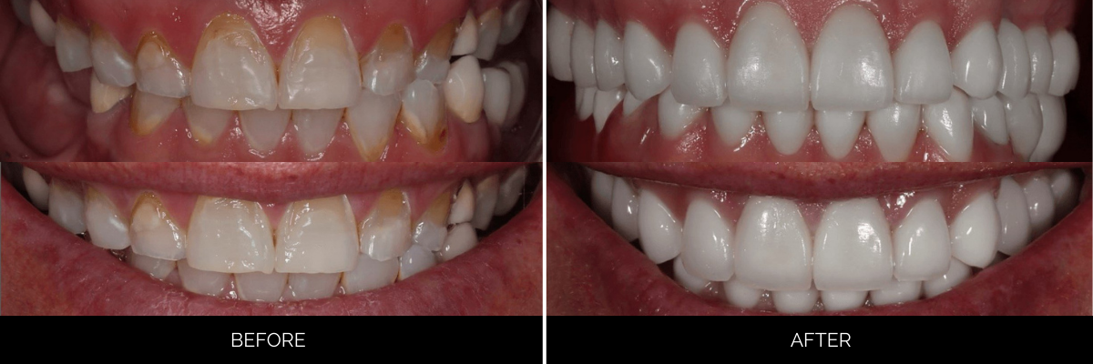 Before and after full-mouth cosmetic veneers: discolored, uneven teeth transformed to bright, uniform smile