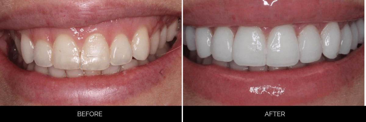 Before and after cosmetic dentistry with reshaped and brightened front teeth