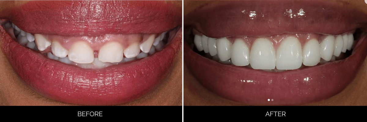 Before and after smile makeover with restored and whitened front teeth