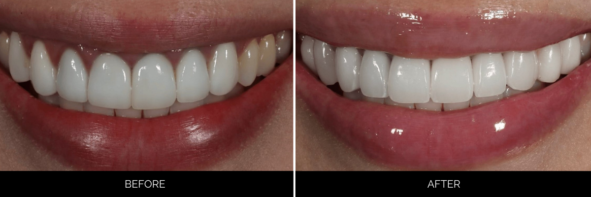 Before and after cosmetic dental treatment showing improved tooth shape and whiteness