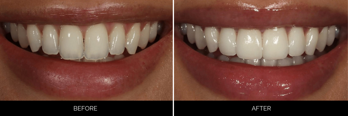 Before and after smile transformation with whiter, more uniform upper front teeth