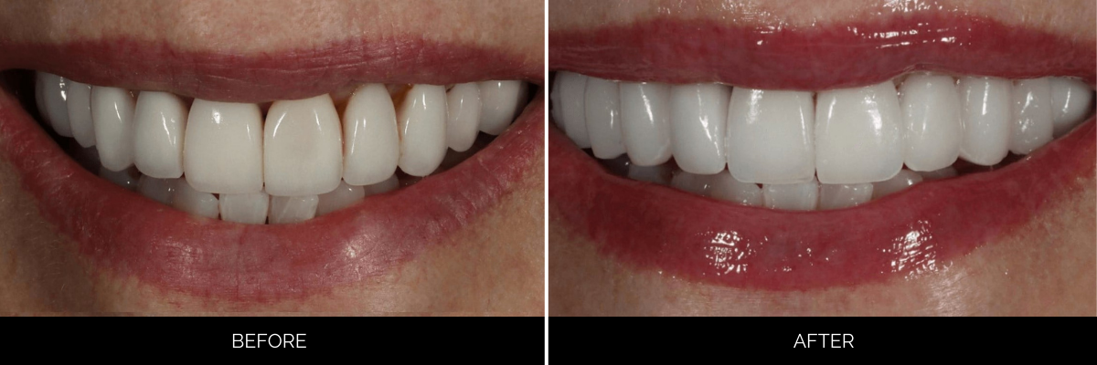 Before and after smile showing tooth whitening and cosmetic veneer enhancement