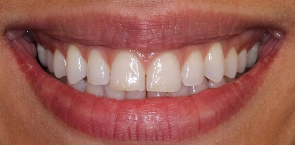 Close-up of patient's bright white smile with veneers