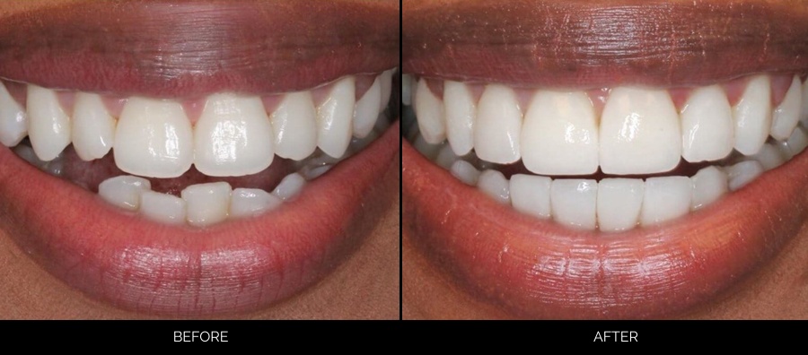 Before and after full mouth restoration with irregular, stained teeth transformed to bright, aligned white smile