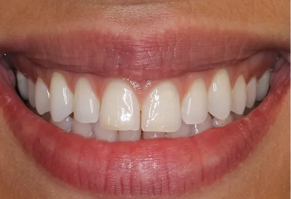 Before photo: close-up of a patient's lower teeth showing uneven spacing and discoloration