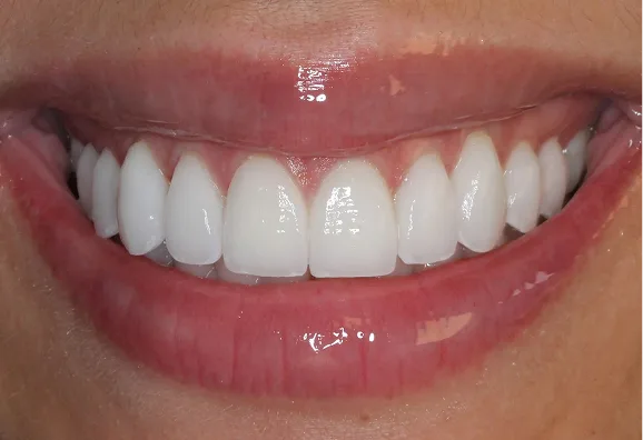 Close-up of a patient's bright white smile showing evenly aligned upper teeth