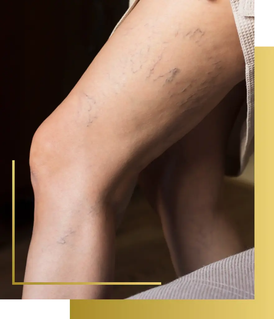 Candidates for Our Vein Treatment Banner
