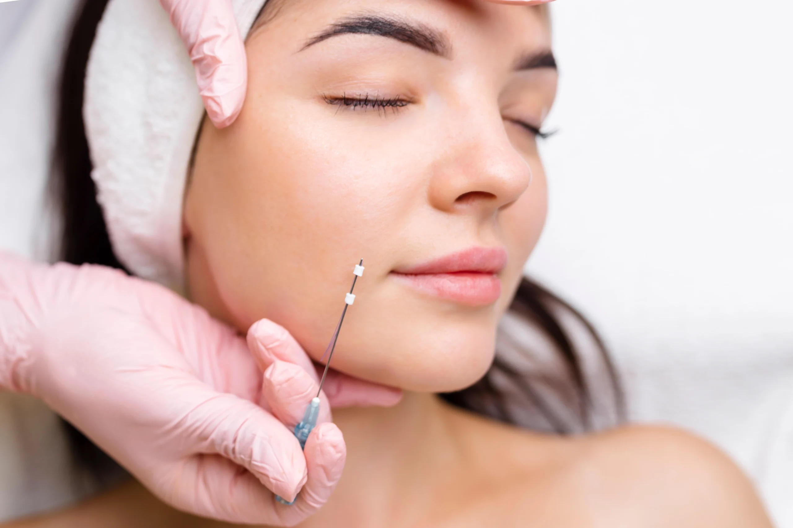 PDO threads being placed in the lower cheek and jawline