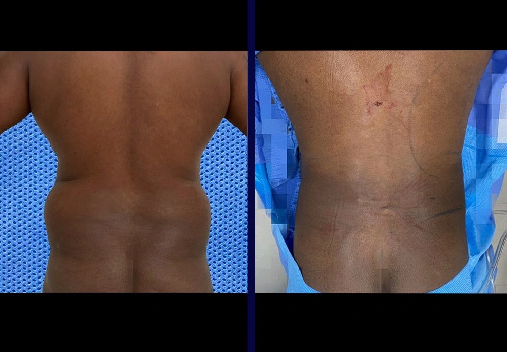 Male liposuction before and after: back view demonstrating enhanced muscle tone and reduced fullness