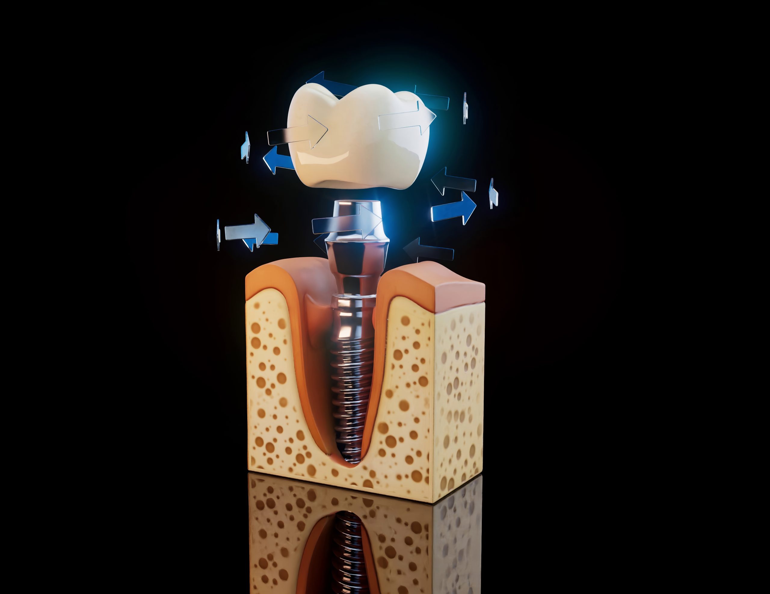 What Are the Benefits of Implant Dentistry? Advantages to Consider Banner
