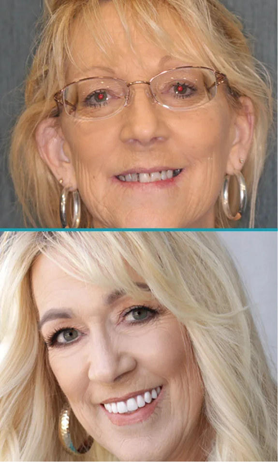 Before and after comparison of woman's smile transformation with cosmetic dental treatment