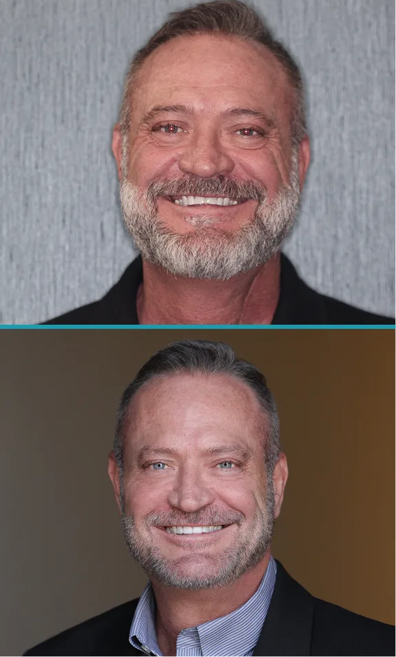 Before and after headshots of man showing improved smile from dental implants