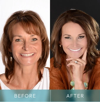 Before and after comparison of woman's smile transformation, labeled Before and After