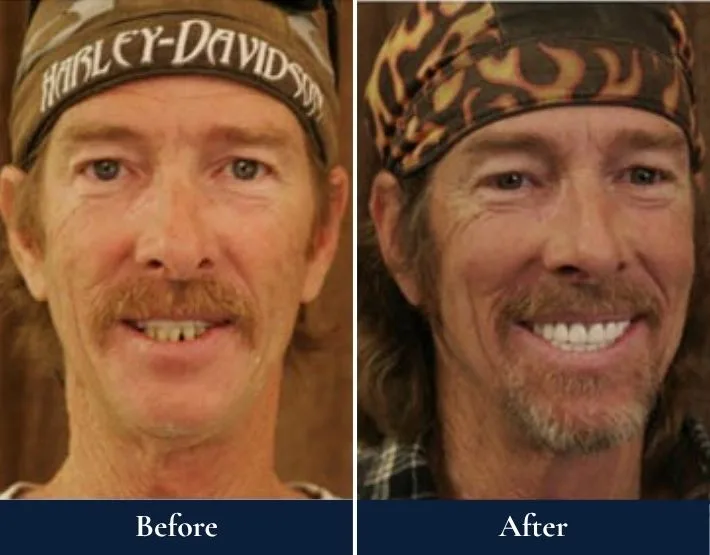 Man's smile before and after full-mouth rehabilitation, showing restored teeth and improved appearance