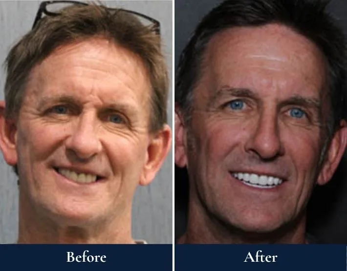 Before and after full-mouth rehabilitation: man with yellowed teeth and worn smile, then with white teeth and confident smile