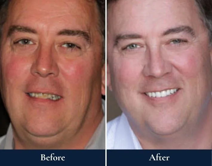 Before and after full-mouth rehabilitation: man with yellowed teeth and uneven bite, then with white teeth and aligned smile