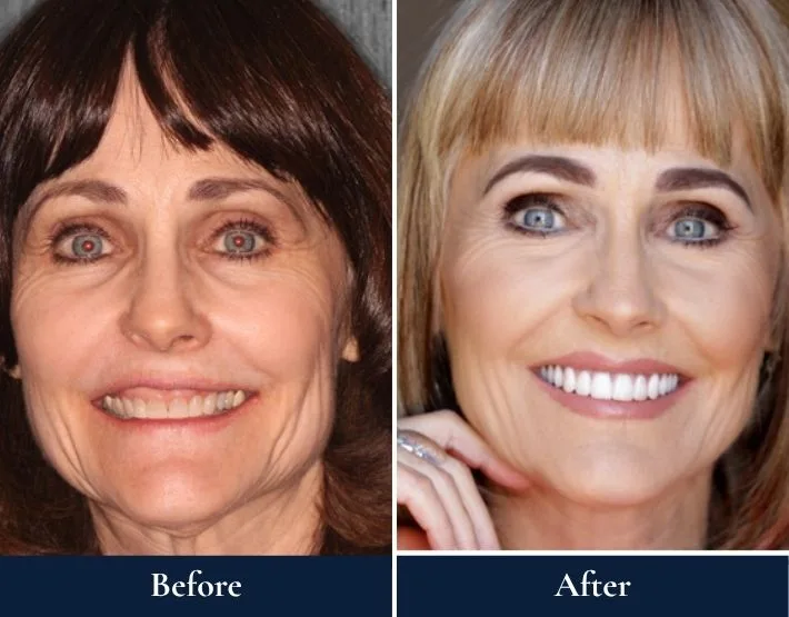 Before and after full-mouth rehabilitation: woman with yellowed teeth, then with bright white teeth and radiant smile