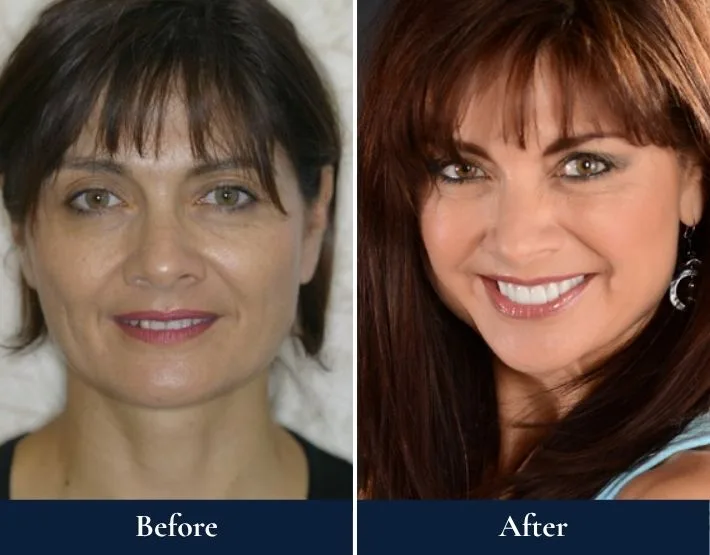 Before and after full-mouth rehabilitation: woman with yellowed teeth and thin lips, then with white teeth and full smile