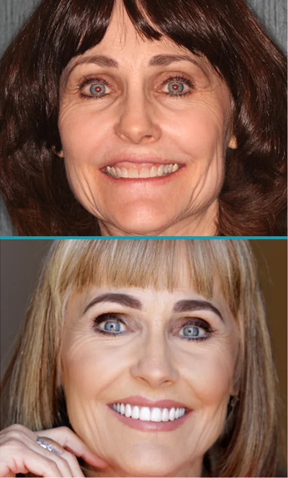 Before and after comparison of woman's smile transformation with cosmetic dental treatment