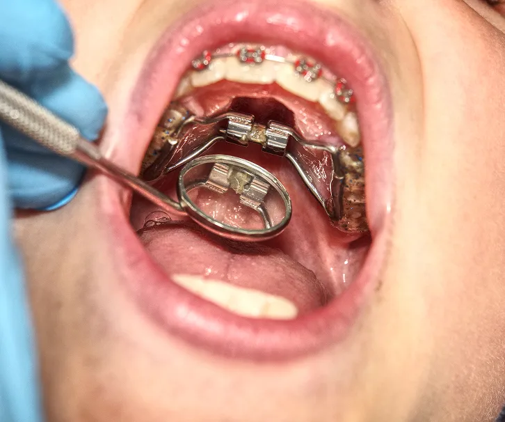 Patient's open mouth showing metal orthodontic braces and palatal expander during dental examination