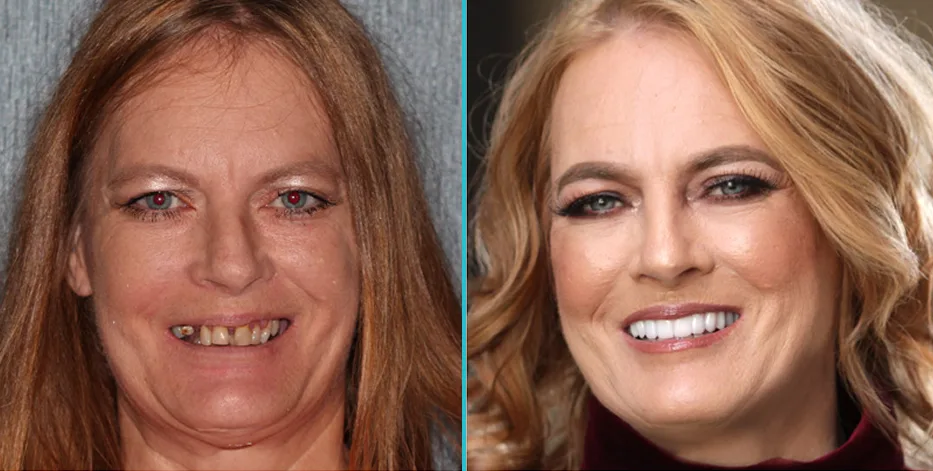 Before and after photos of patient smile transformation with improved tooth color and alignment