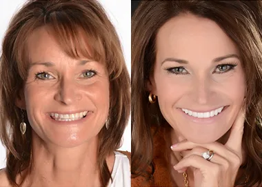 Before and after dental smile comparison showing woman's teeth transformation