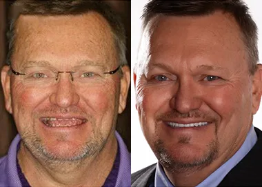 Before and after headshots of male patient showing improved smile and tooth alignment