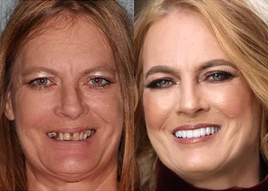 Before and after headshots of female patient showing improved smile and tooth appearance